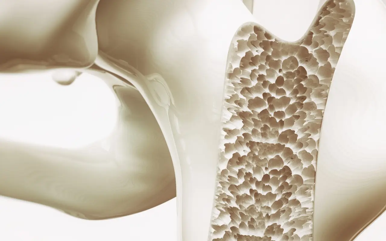 Soffri di osteoporosi grave? Ecco quando hai diritto all’invalidità e alle agevolazioni